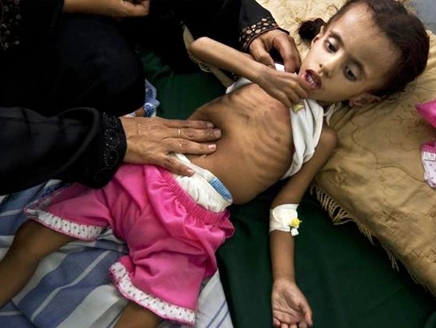سوء التغذية في اليمن يتجاوز المعايير الدولية